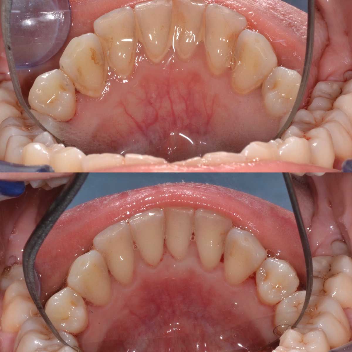 Sbiancamento elettrico dei denti tartaro dentale Scaler placca